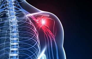 Rotator Cuff Syndrome